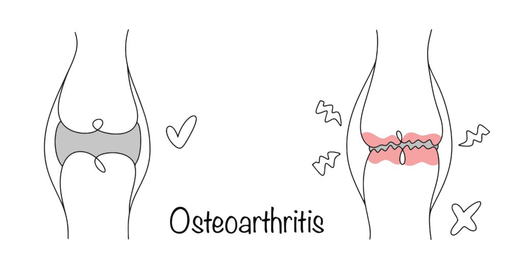 O que é artrose ou osteoartrite?