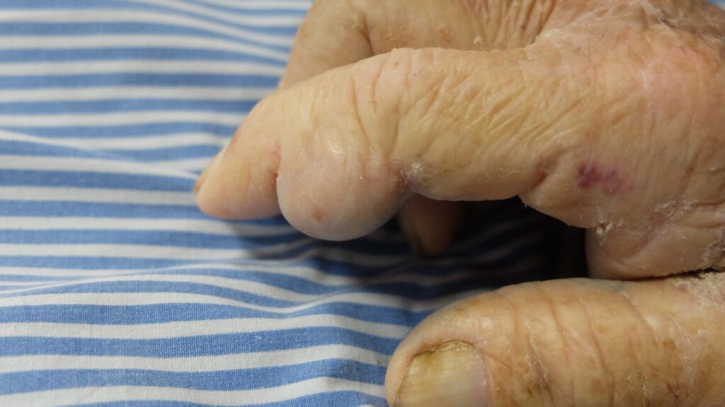 Paciente com gota, ácido úrico alto e tofos gotosos