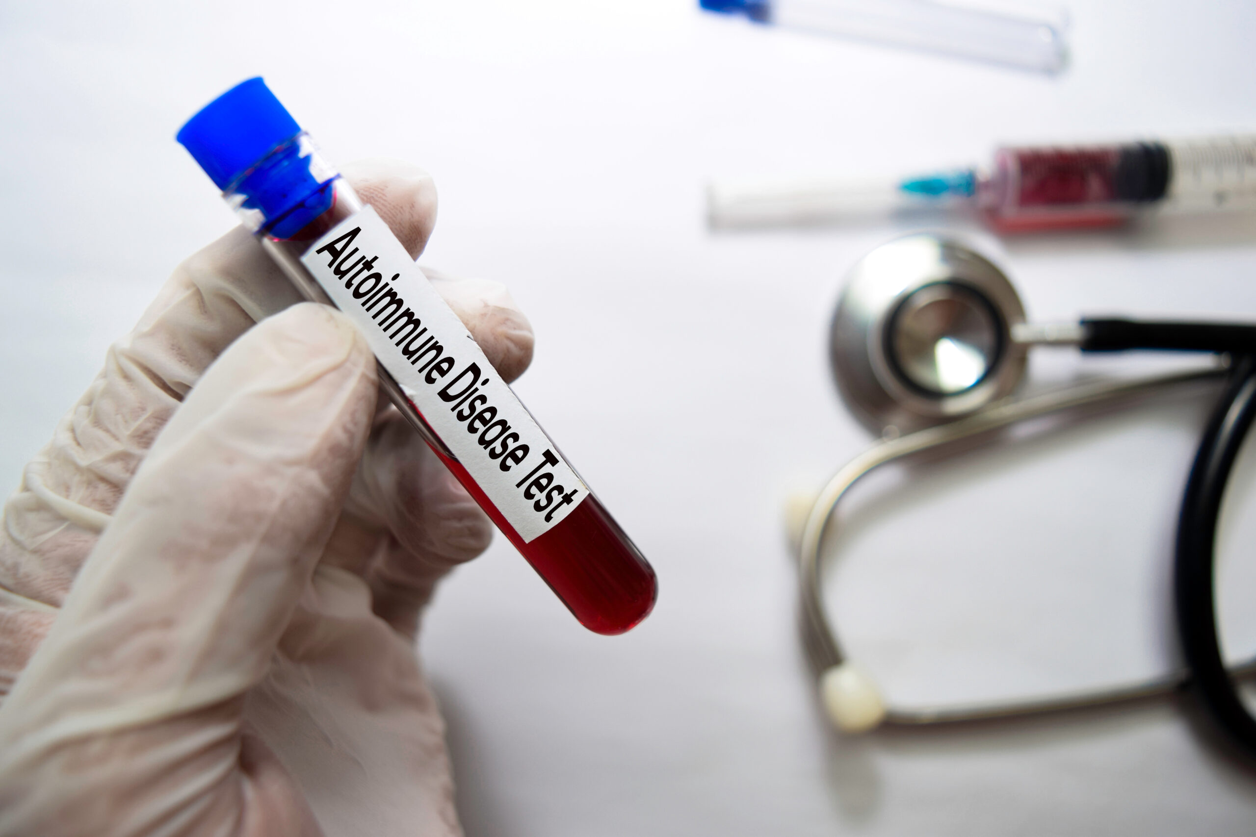 Teste do FAN para diagnóstico de Lúpus