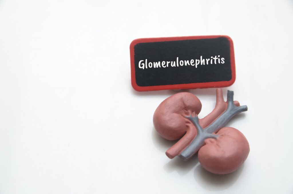 Sintomas de Lúpus: nefrite